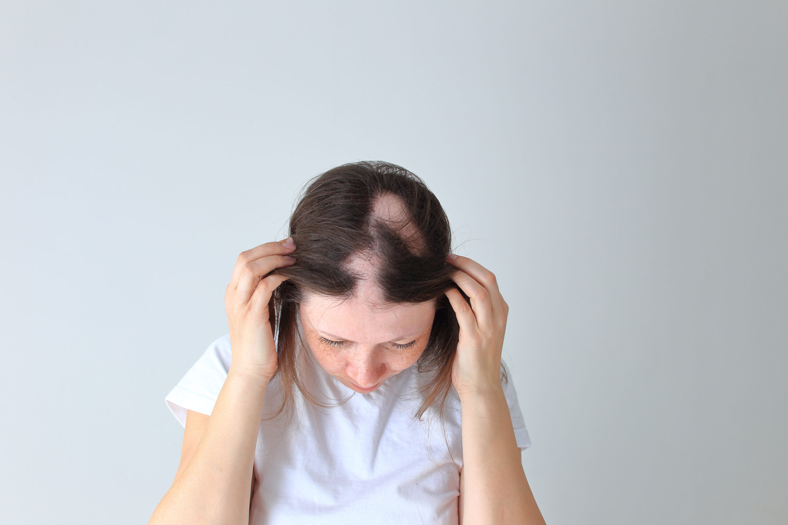 Real,Alopecia,Areata,In,A,Young,Girl.,A,Bald,Head alopecia areata