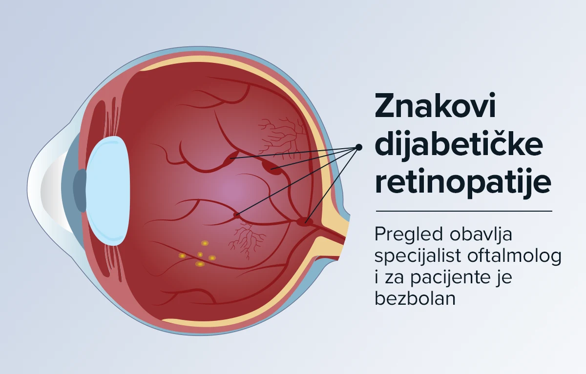 Ilustracija znakova dijabetičke retinopatije. Pregled obavlja specijalist oftalmolog i za pacijente je bezbolan.