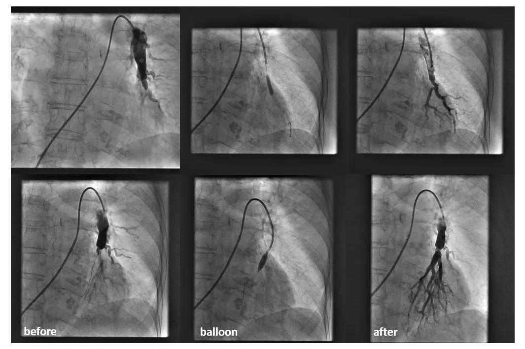 Prikaz rendgenske slike začepljenih plućnih arterija; endovaskularno otvorena plućna arterija