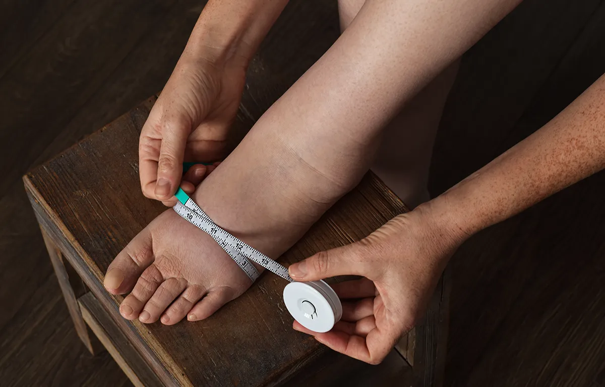 limfdem-mjerenje Neprepoznatljiva žena s limfdemom mjeri obujam nateknutog stopala; koncept savjeti o limfedemu