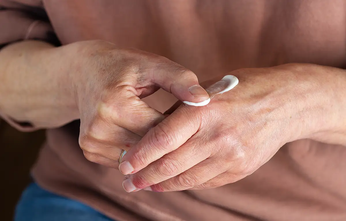 Neprepoznatljiva starija žena njeguje kremom dermatitis; poremećaji kože kose i noktiju kod liječenja raka dojke