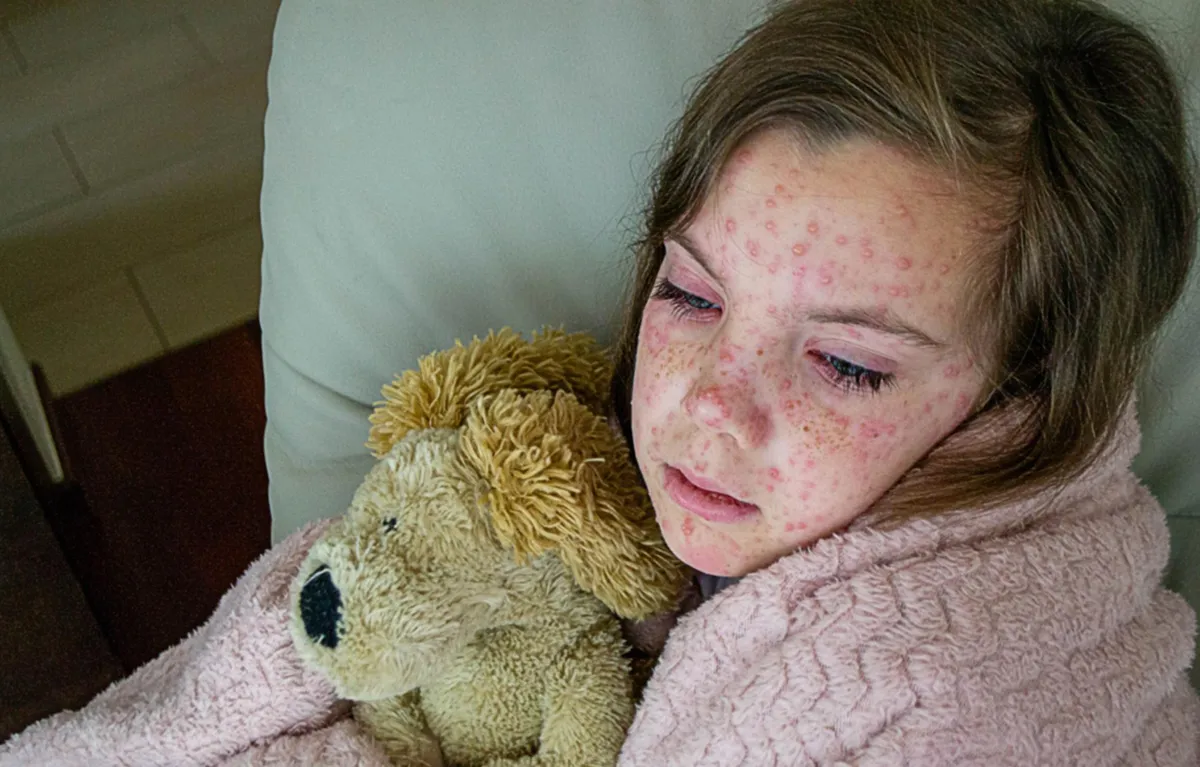 ospice-kod-djece-izvjestaj Djevojčica oboljela od ospica, ilustrativna fotografija; izvještaj SZO umrli od ospica