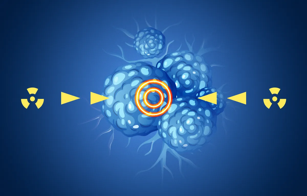 Ilustrativni prikaz radioligandna terapija kod liječenja raka prostate.