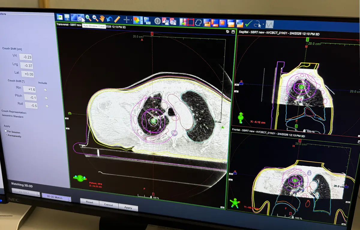 Medicinski ekran prikazuje postupak stereotaksijska tjelesna radioterapija (SBRT) pluća, na Klinici za tumore KBC-a Rijeka