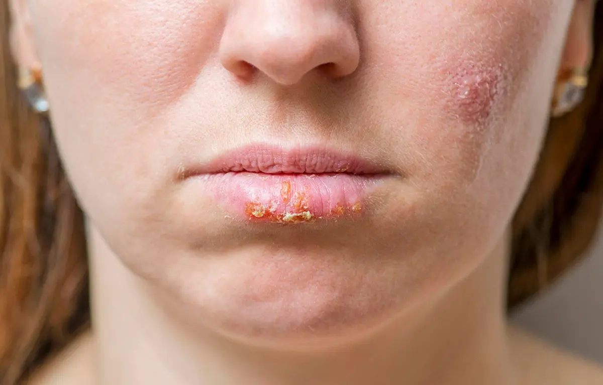 Lice žene u krupnom planu na čijim je usnama herpes; tema herpes virusi, savjete i objašnjenja daje obiteljska liječnica dr. Martina Beljan.